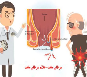سرطان مقعد-علائم سرطان مقعد